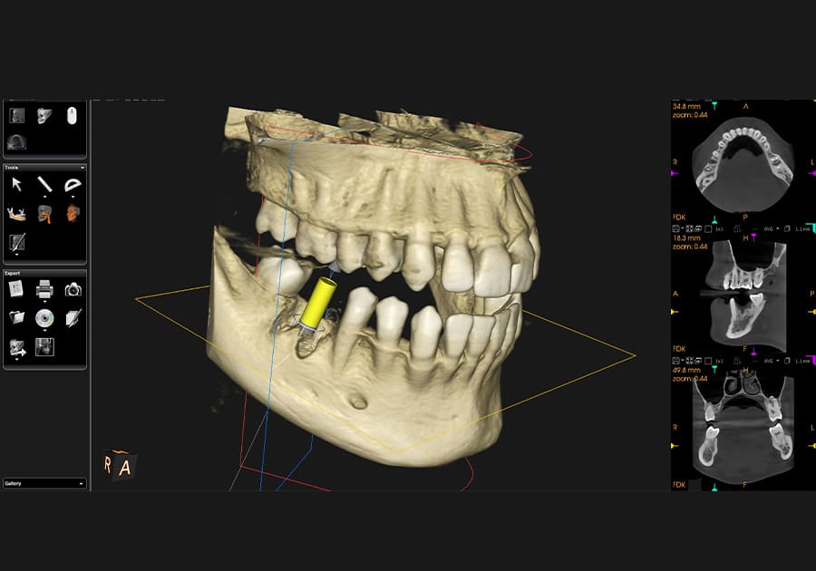 歯の3Dシミュレーションのイメージ