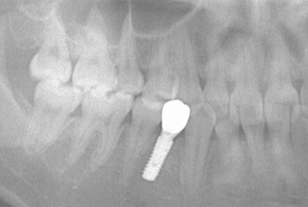 case2_治療後_レントゲン
