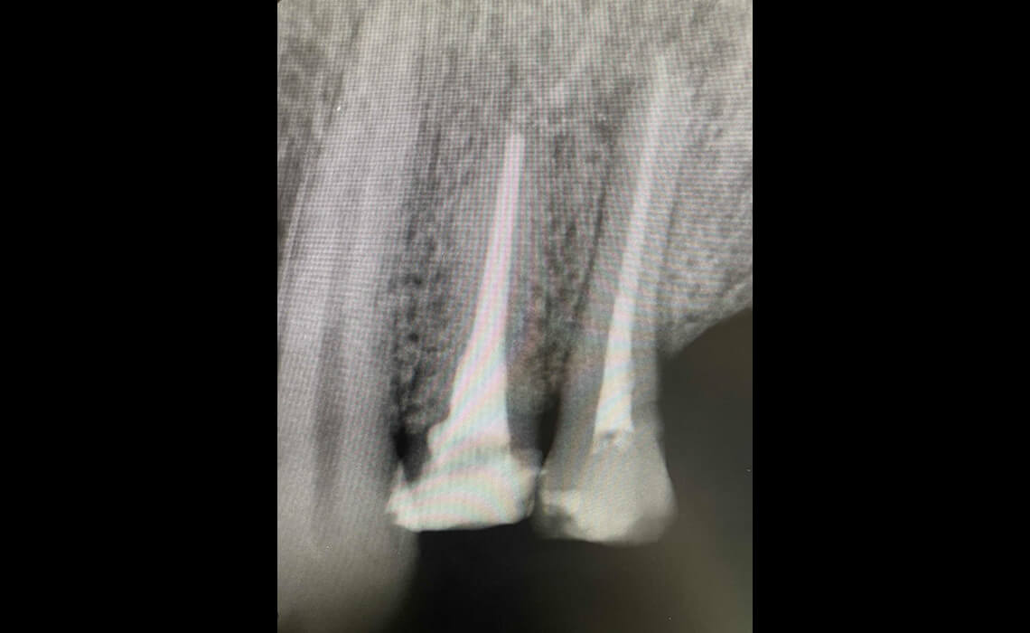 根管治療の症例_治療後1