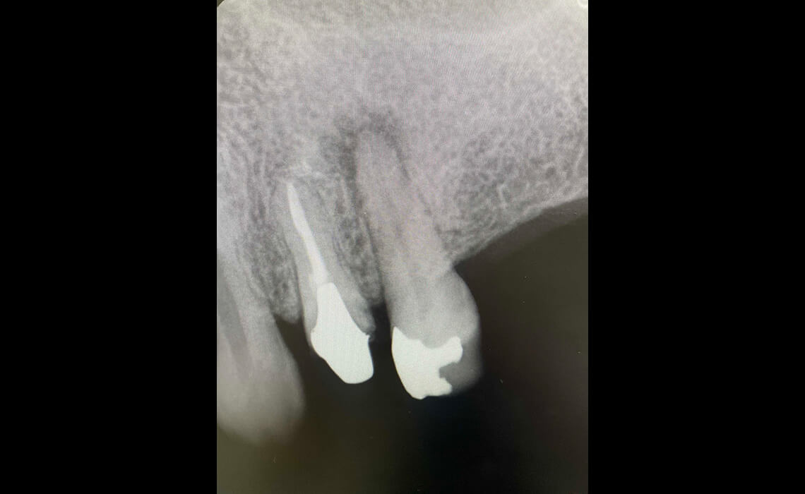 根管治療の症例_治療前1