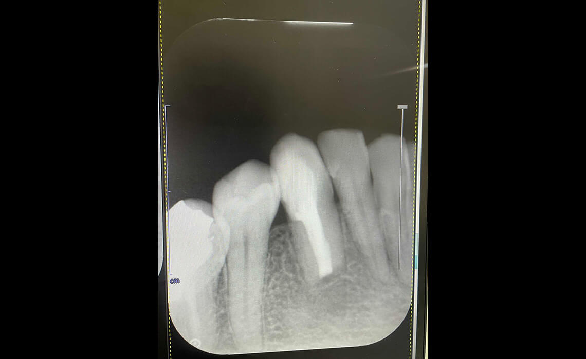 根管治療の症例_治療後2