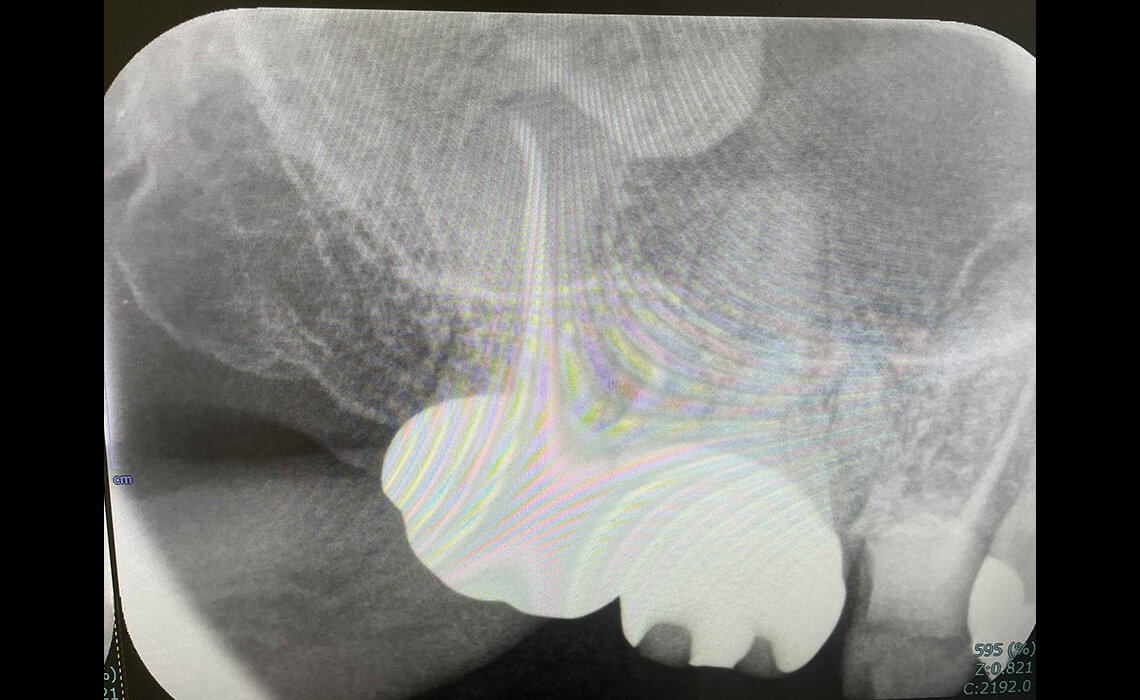 根管治療の症例_治療後3