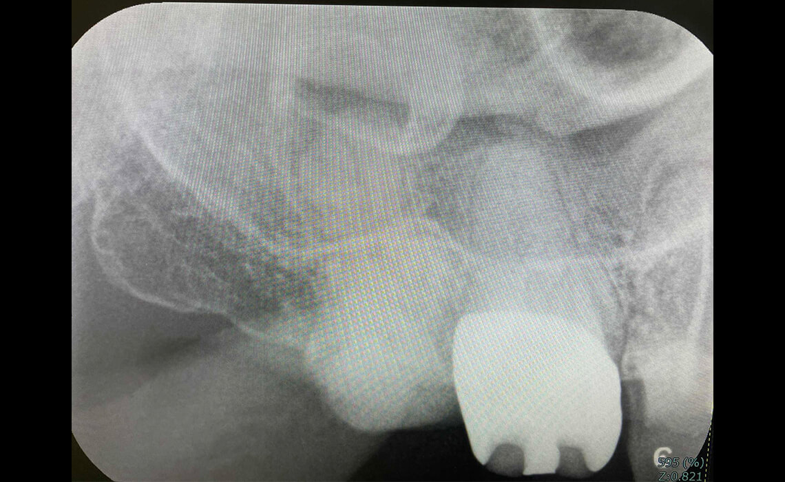 根管治療の症例_治療前3