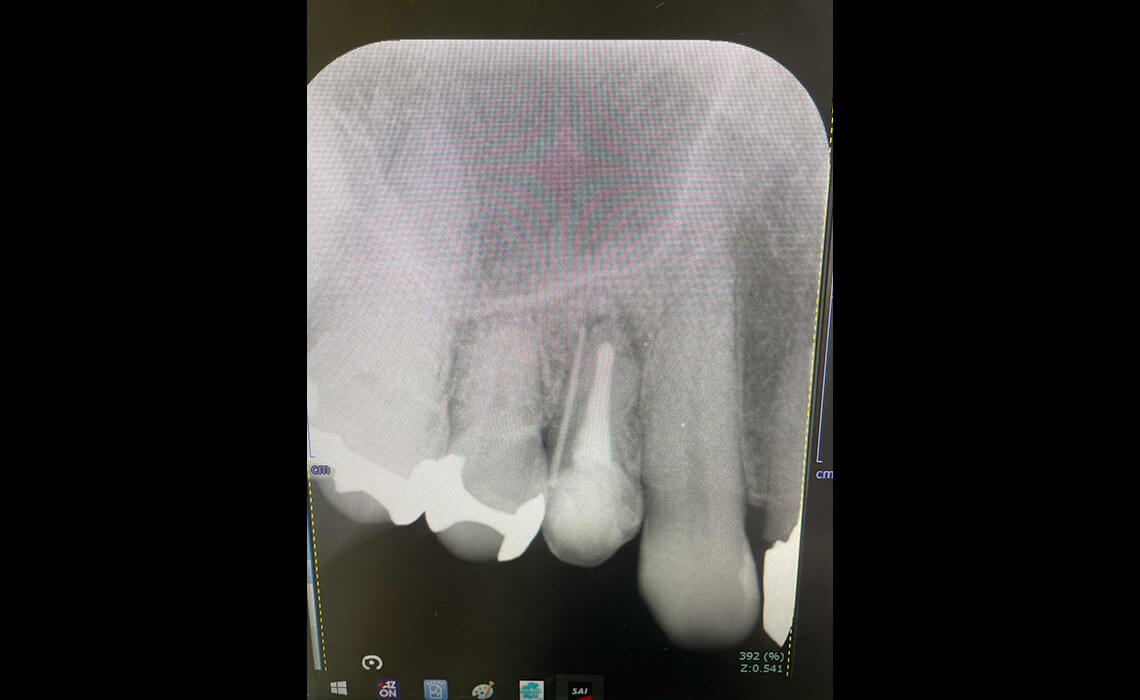根管治療の症例_治療前4